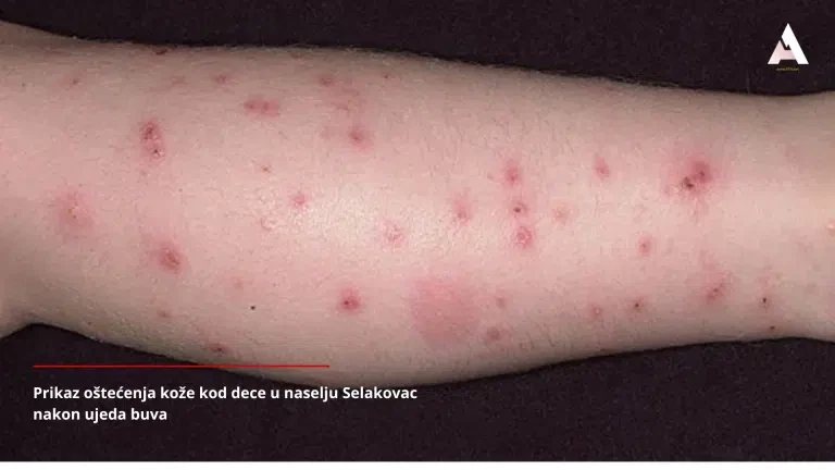 Meštani Selakovca ne izlaze iz kuće zbog najezde buva: “Deca izujedana, strah se širi kroz naselje” (VIDEO)