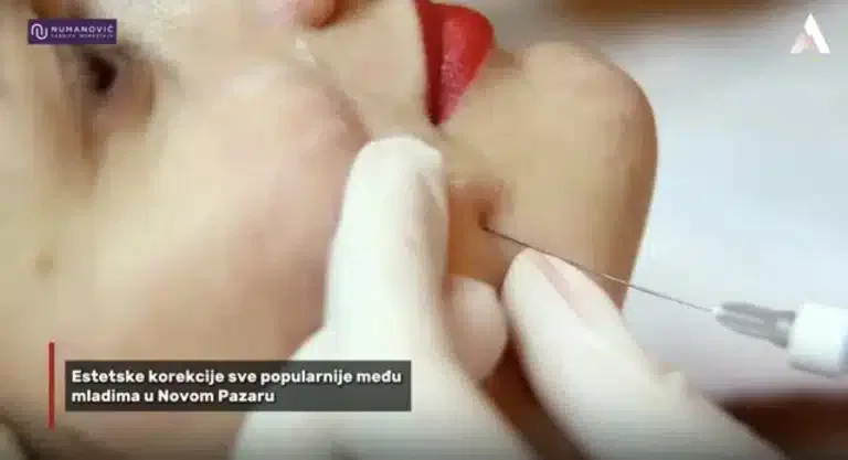 Estetske korekcije sve popularnije među mladima u Novom Pazaru (VIDEO)
